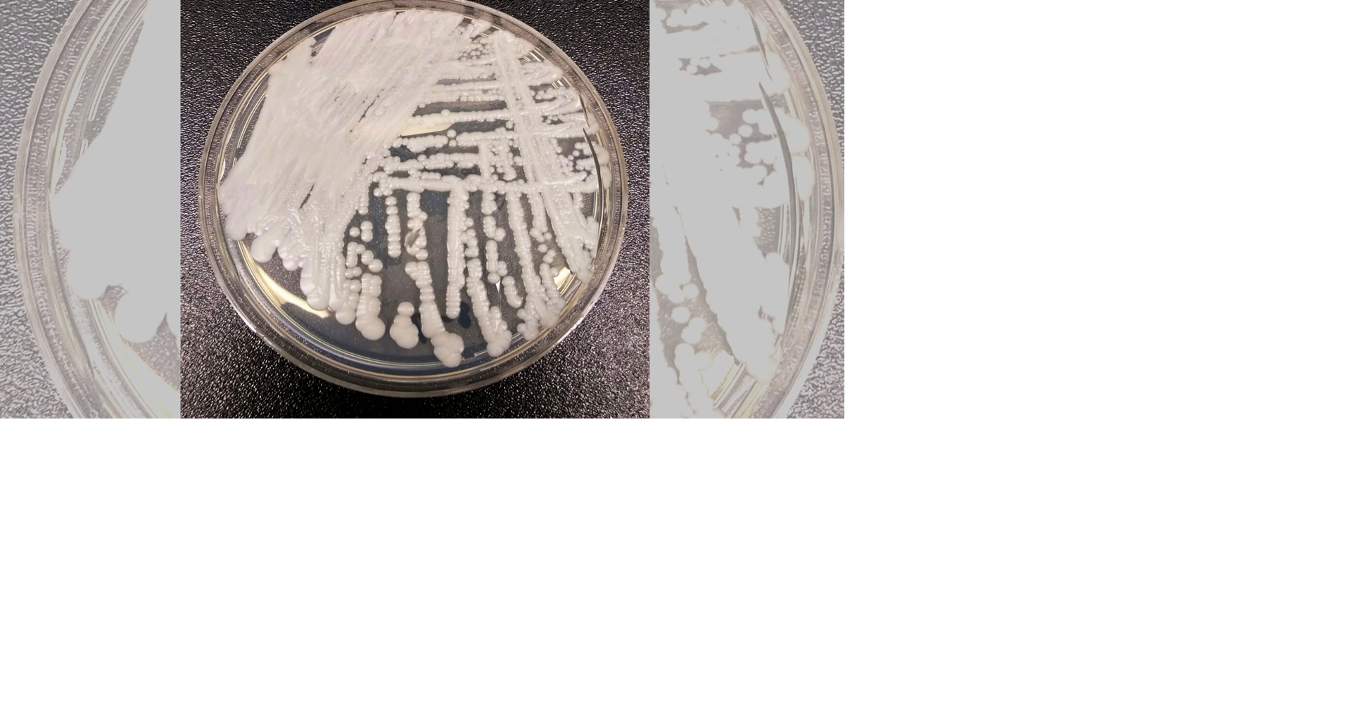 Drug-resistant fungus Candida auris spreading across US, but doctor says healthy people face low risk