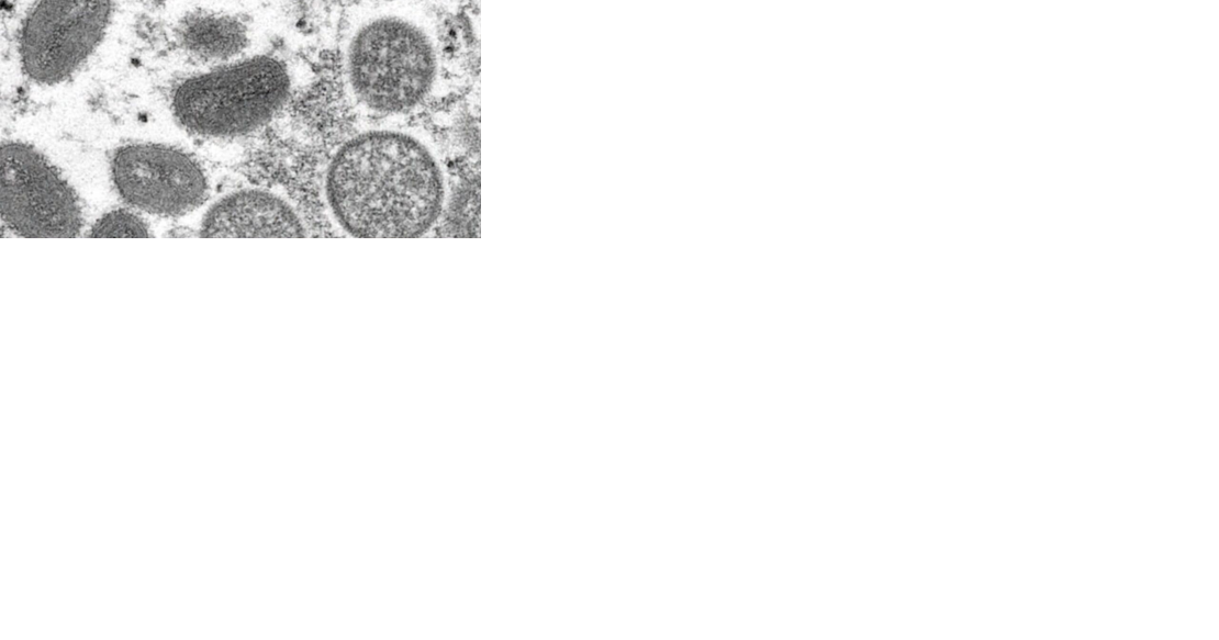 Health officials worried about Mpox resurgence after last year's outbreaks - Vimarsana News