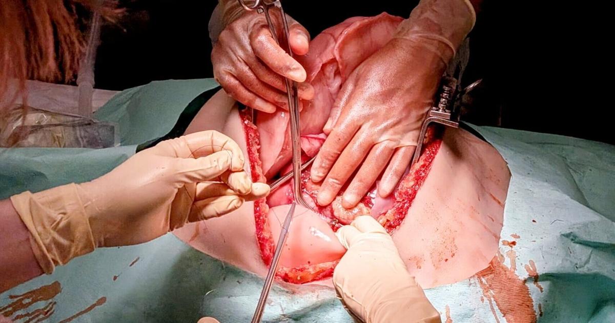 New 3D-printed ‘bleeding’ torsos used to train trauma surgeons | Health New 3D-printed ‘bleeding’ torsos used to train trauma surgeons | Health