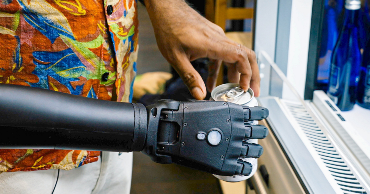 Amputee gets world’s first whole 3D bionic arm | Health Amputee gets world’s first whole 3D bionic arm | Health