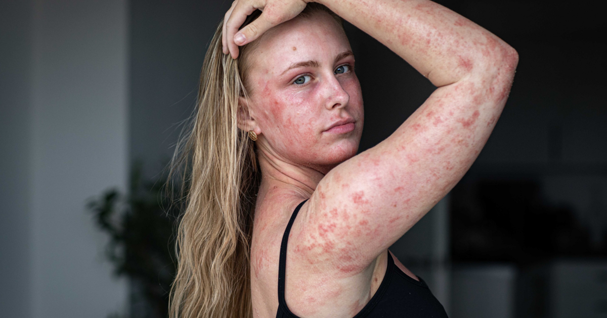 Woman left in agony after eczema cream leaves 95% of skin in pain | Health Woman left in agony after eczema cream leaves 95% of skin in pain | Health