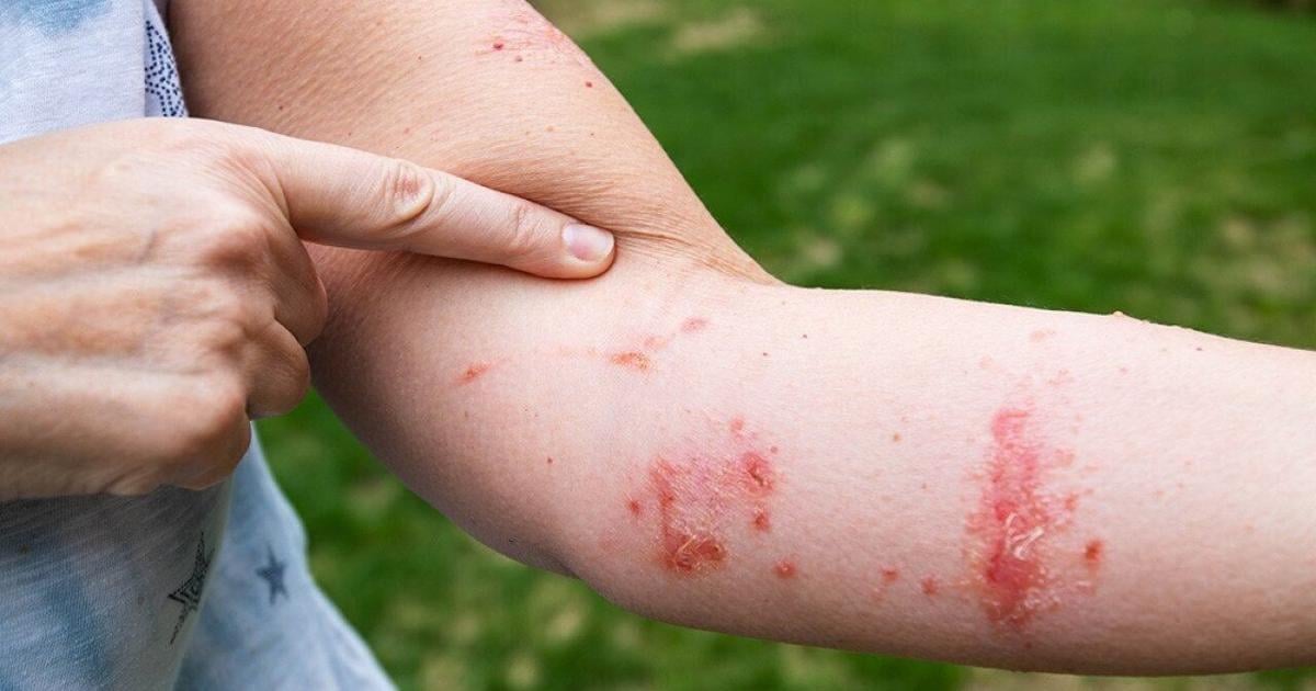 6 ways to get rid of poison ivy rash symptoms fast | Health 6 ways to get rid of poison ivy rash symptoms fast | Health