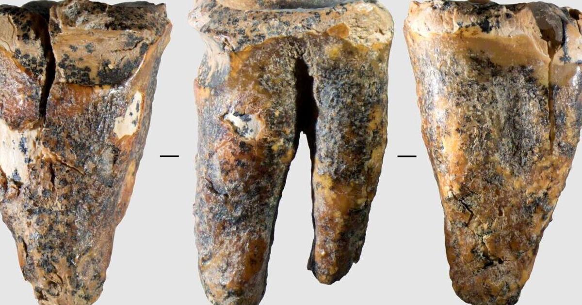 Tooth shows cavemen conducted dental surgery before anesthesia | Health Tooth shows cavemen conducted dental surgery before anesthesia | Health