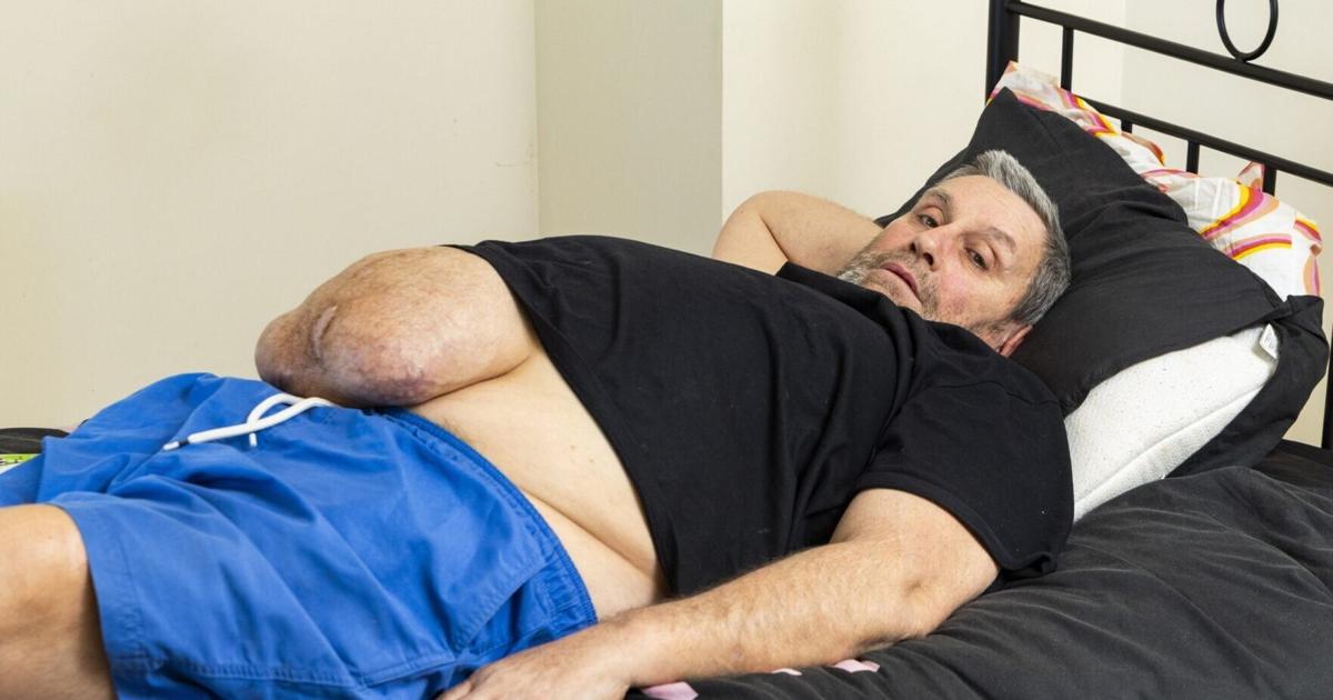 Man fundraising for surgery to remove watermelon-sized mass | Health Man fundraising for surgery to remove watermelon-sized mass | Health
