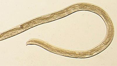 Woman pulls parasitic worms from her eye after running through