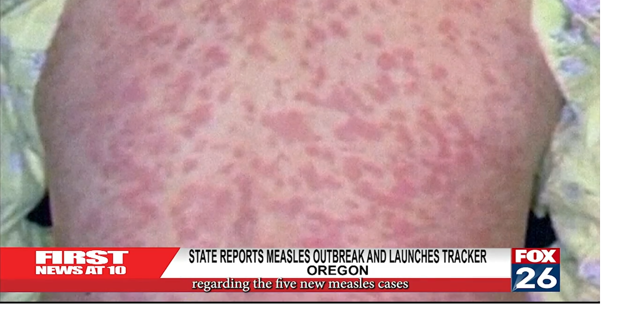 State Reports Measles Outbreak And Launches Tracker | Local ...