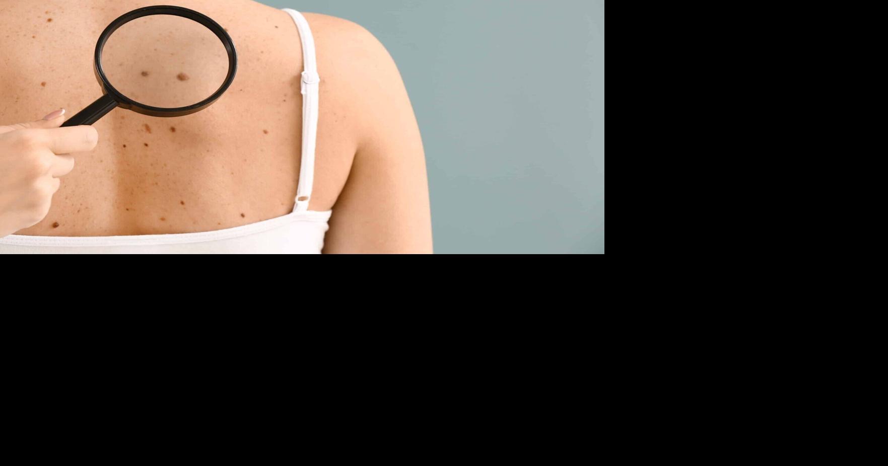 Read moreFree skin cancer screening event set for July 25 in Jacksonville