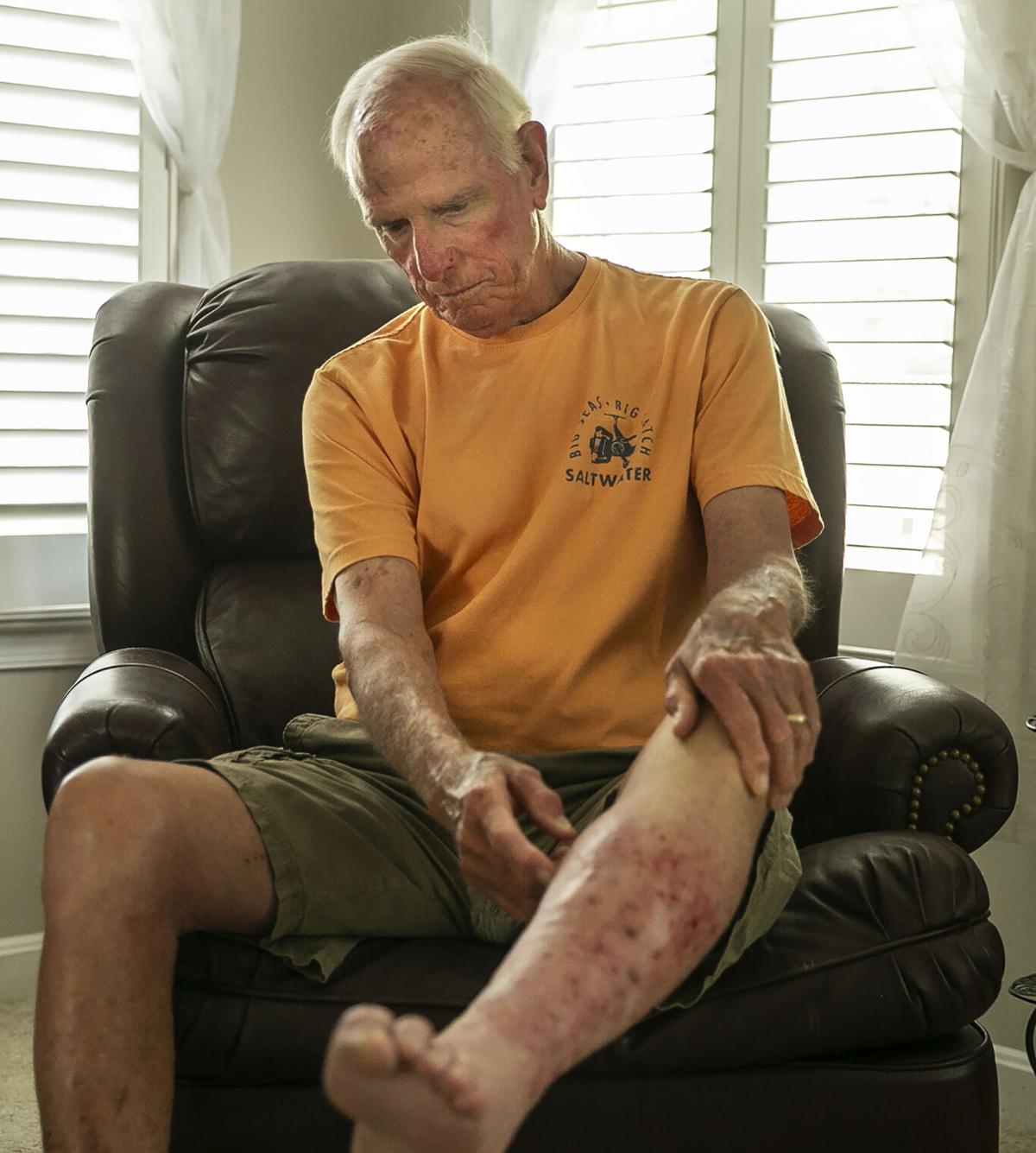 Spotsylvania man almost lost leg to flesh-eating bacteria