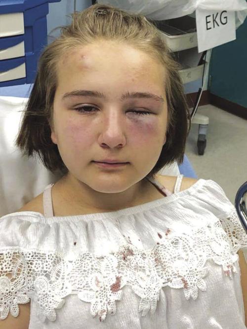 Mother blames bullying; may need surgery