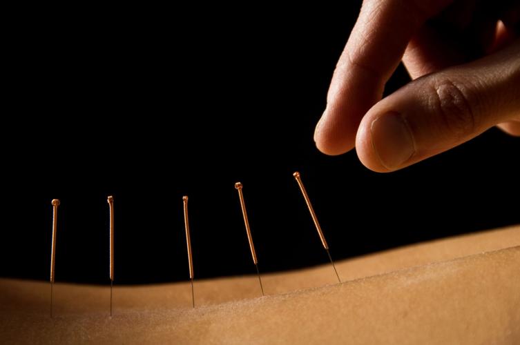 Acupuncture Ancient Chinese Healing Art Finds New Role In Modern