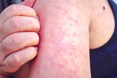 Measles