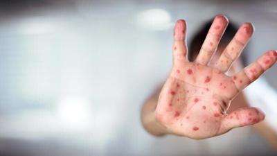 Measles pic.jfif
