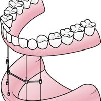 Implant-retained dentures: A solution for those with lower ridge resorption