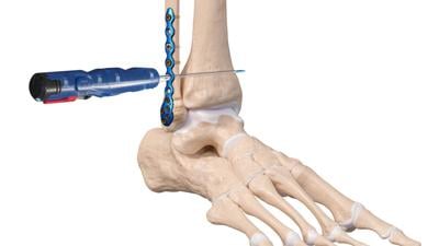 Arthrex ankle implant technology