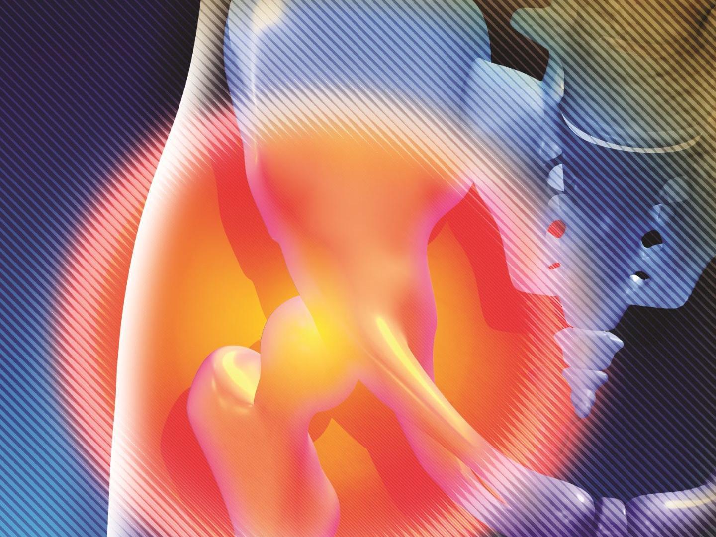 Treating Gluteus Medius Tendinopathy Features Hanfordsentinel Com