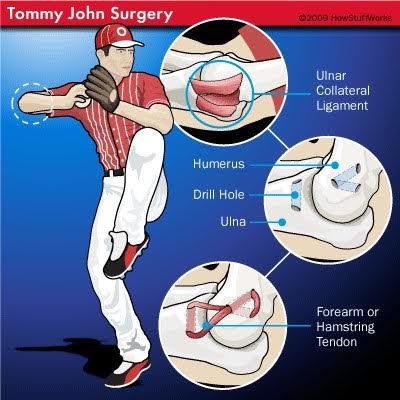 ecstasy Glimte Profeti Elbow injuries in Major League Baseball throwers: Part II | Advice |  hanfordsentinel.com