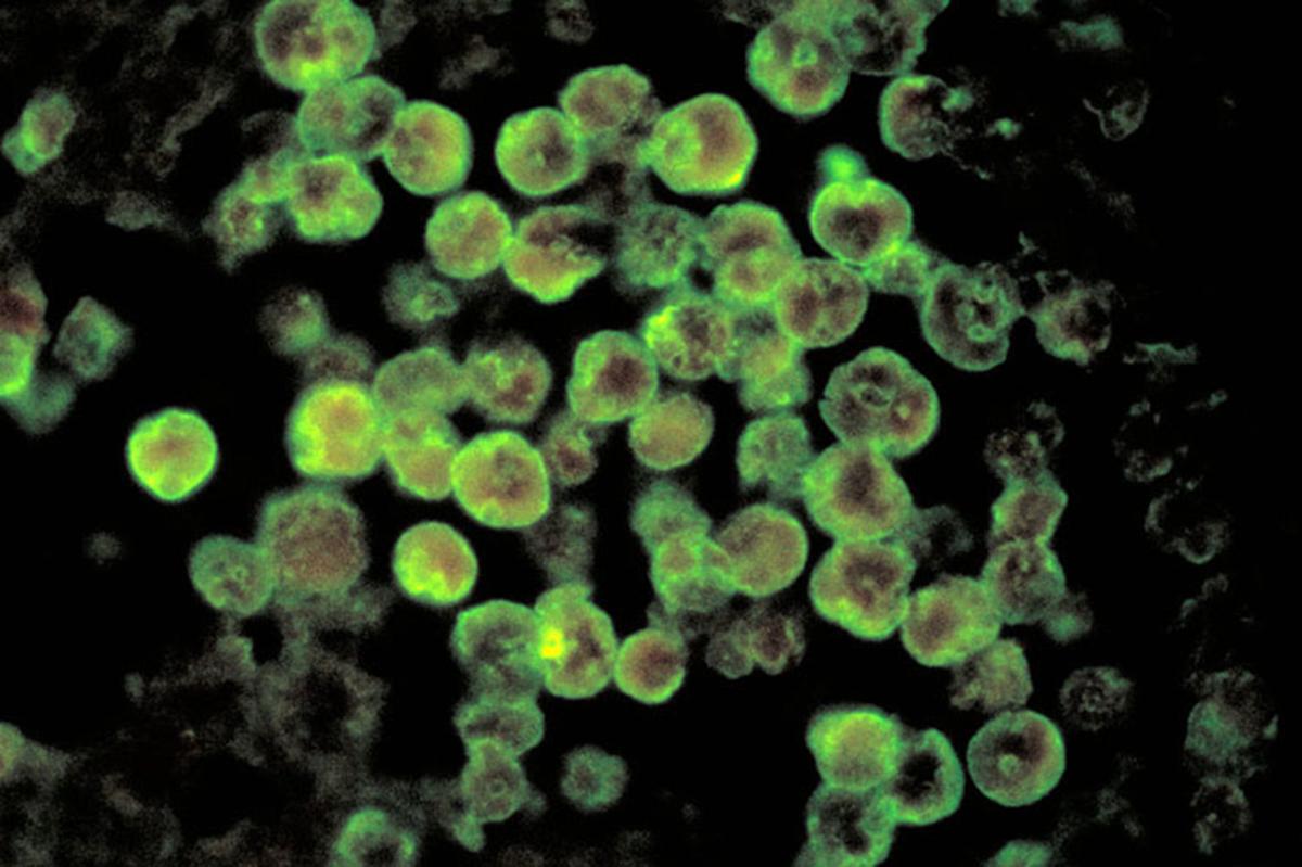 US NEWS MED-AMOEBAS-INFECTION 1 KHN