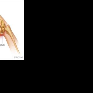 Mayo Clinic Minute: Reducing thumb arthritis pain