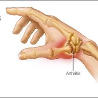 Mayo Clinic Minute: Reducing thumb arthritis pain