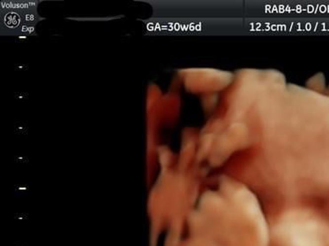 Decatur S Baby Face Hd Ultrasound Offers Sneak Peek Of Growing