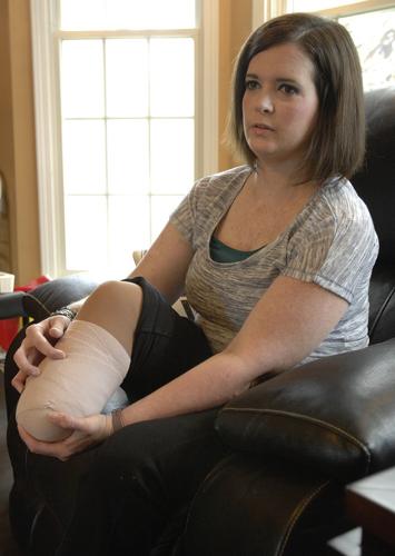 Woman says part of leg amputated after broken foot went undiagnosed for 2  months