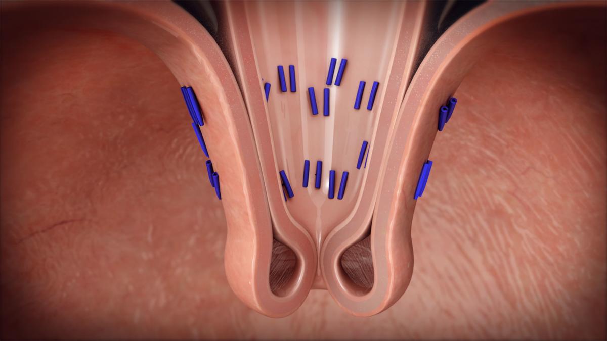 Procedure restores esophageal valve, quells acid reflux Features
