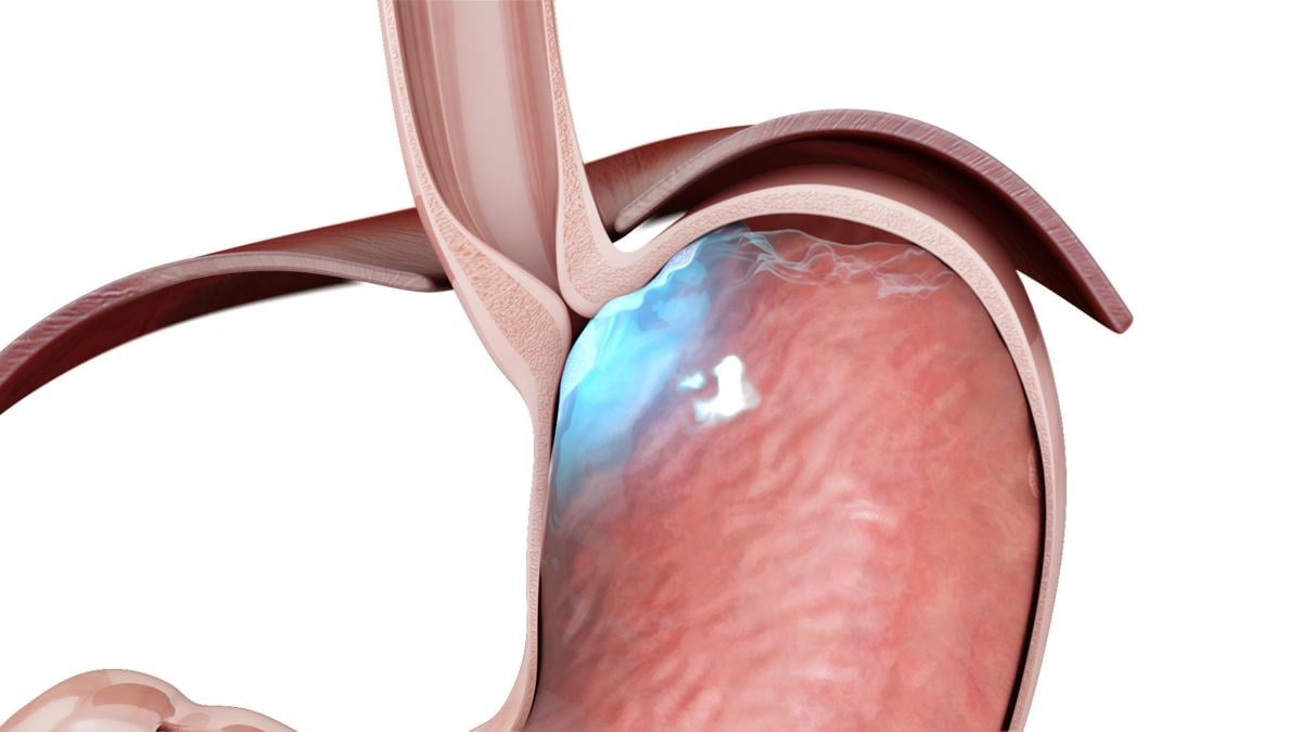 Procedure restores esophageal valve, quells acid reflux Features