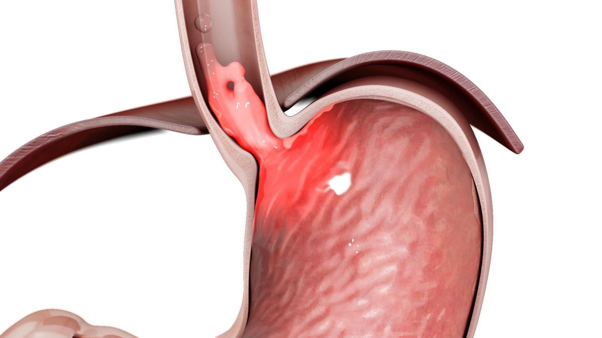 Procedure restores esophageal valve, quells acid reflux Features