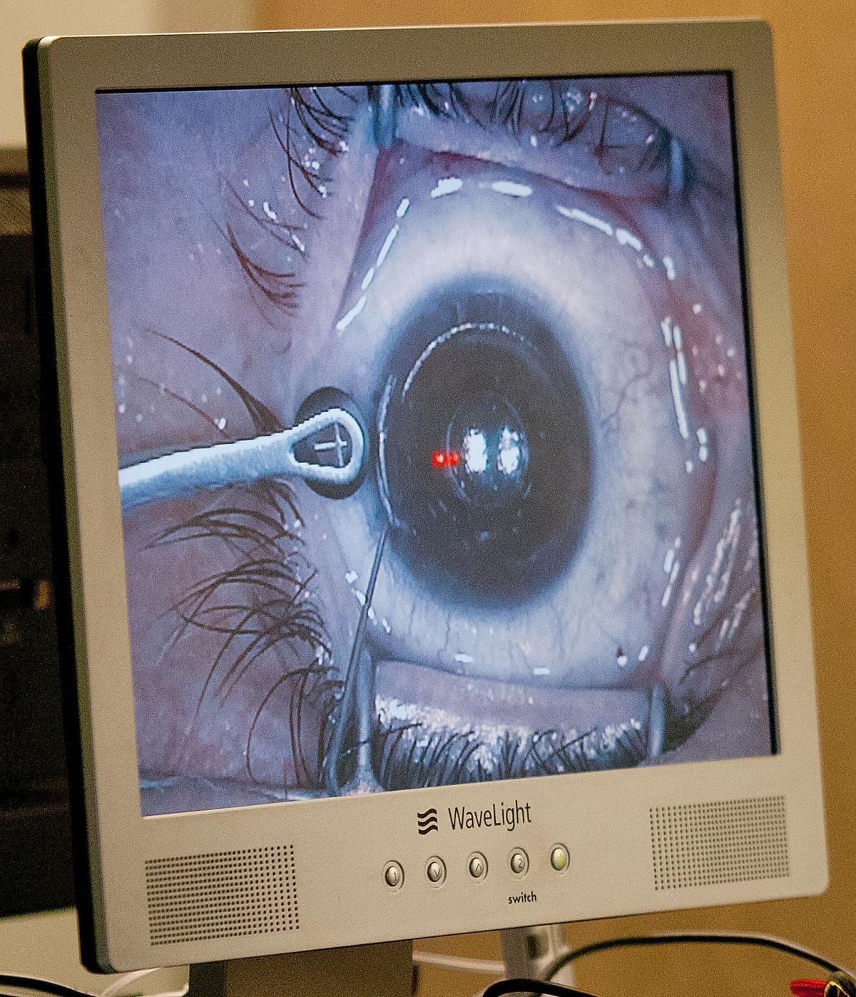 Camera inlay eye surgery