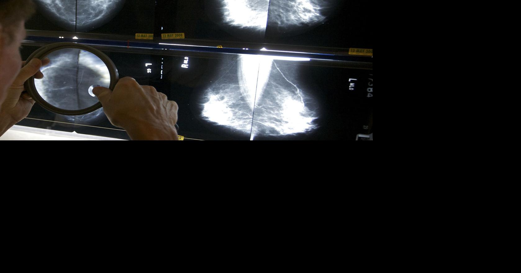 Mammograms After Cancer