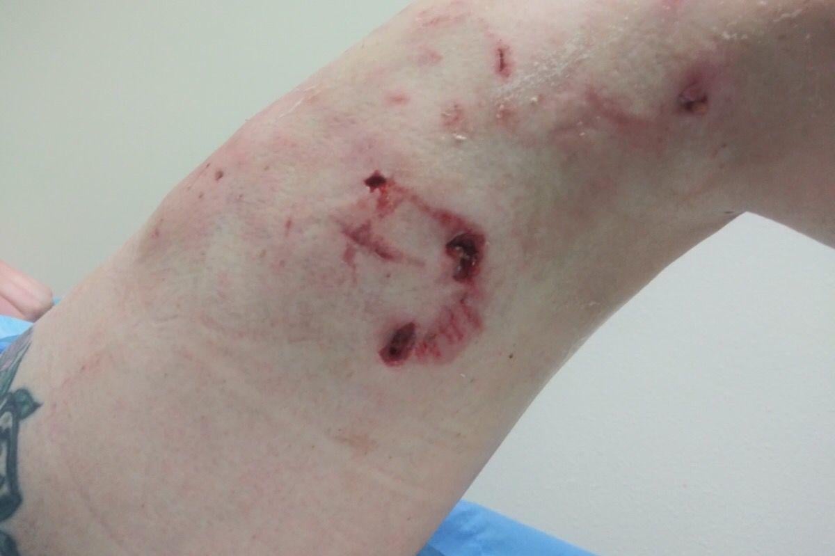 pit bull attack leaves local woman with