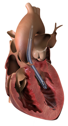 Impella 5.5