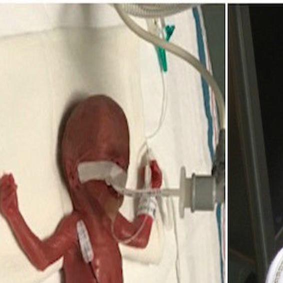 Miracle Baby Infant Born At 24 Weeks Finally Gets To Go Home From Hospital Local Idahostatejournal Com