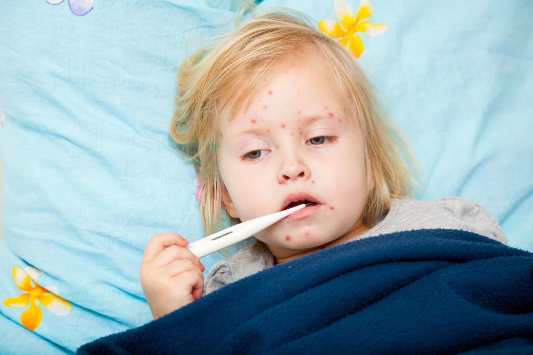 MEASLES