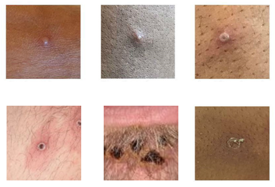 Monkeypox
