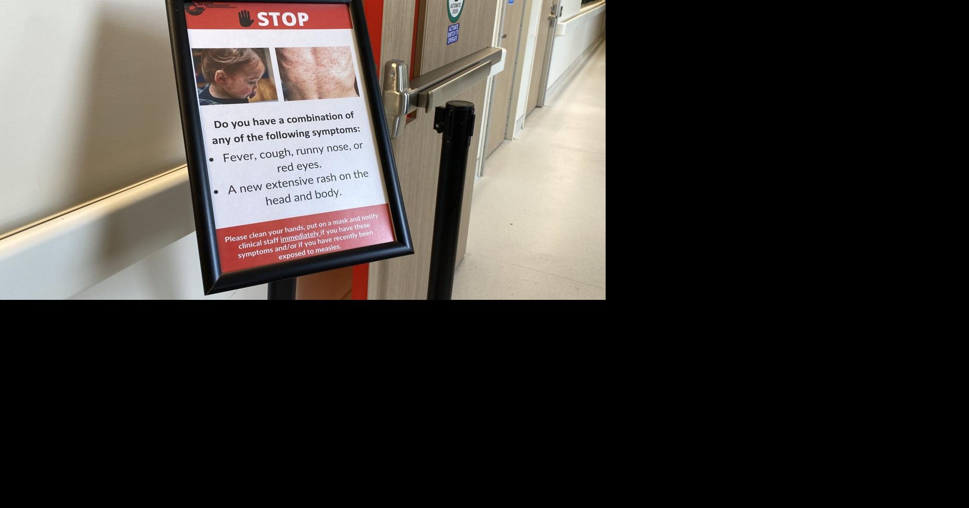 Canada loses measles elimination status
