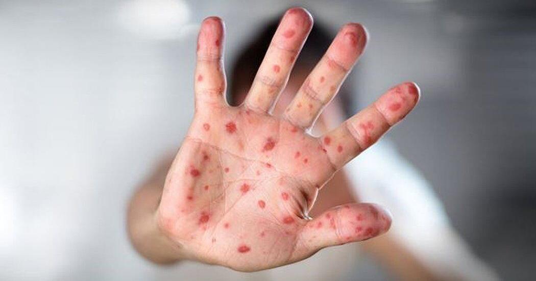 New outbreak-related measles cases falls again in Ontario