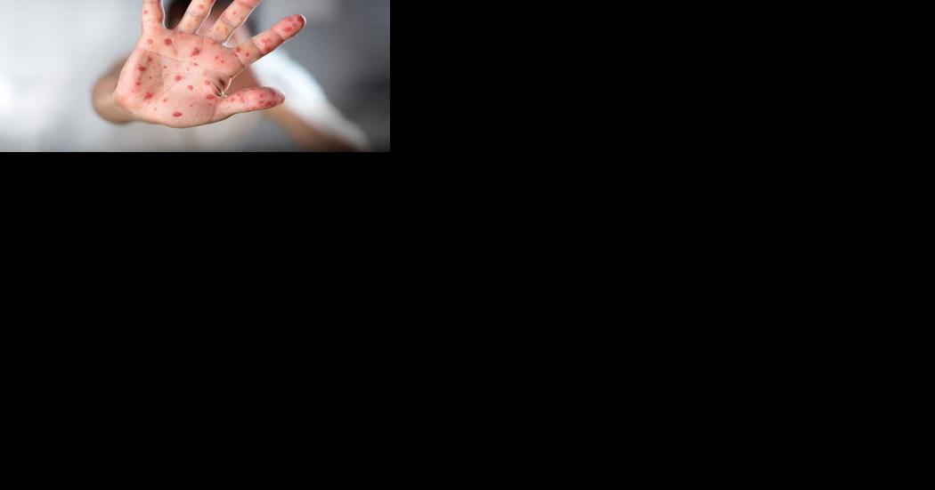 Oakville, Georgetown locations flagged for possible measles - Vimarsana News