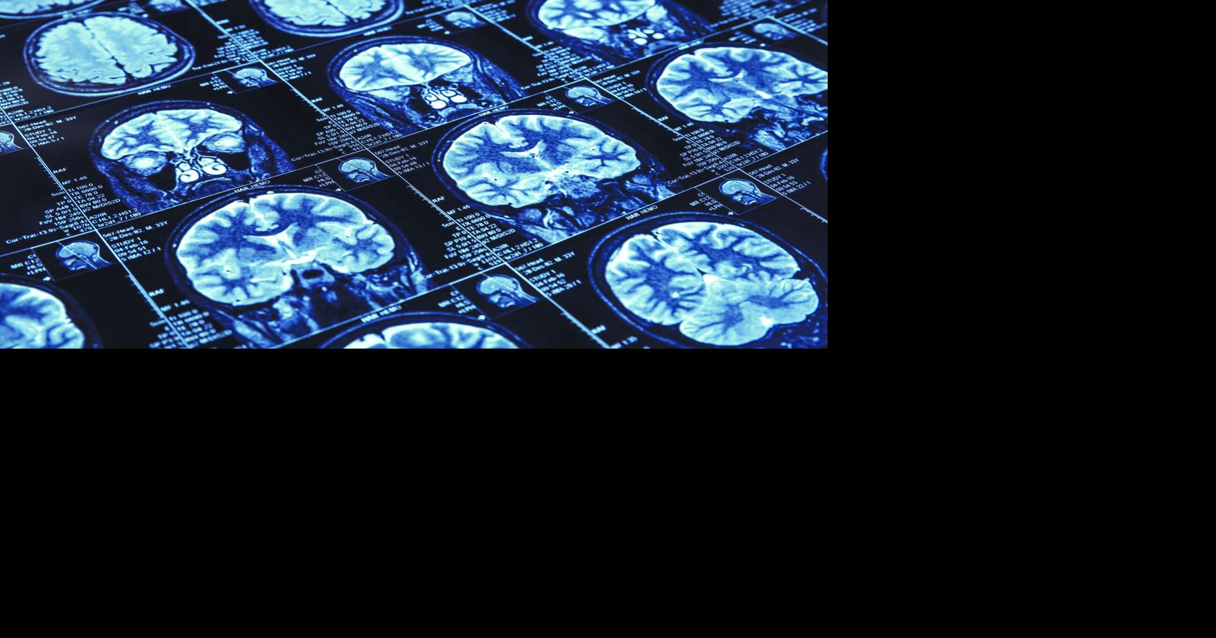 U.Va. researchers ID potential way to stop brain injuries from triggering Alzheimer’s