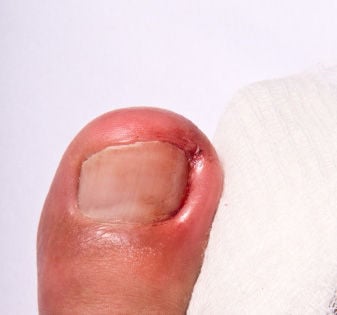 ingrown toenail