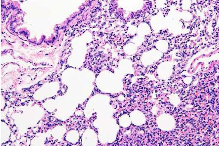A bacterial protein fragment drives tissue fibrosis, but antibody treatment can help, study finds