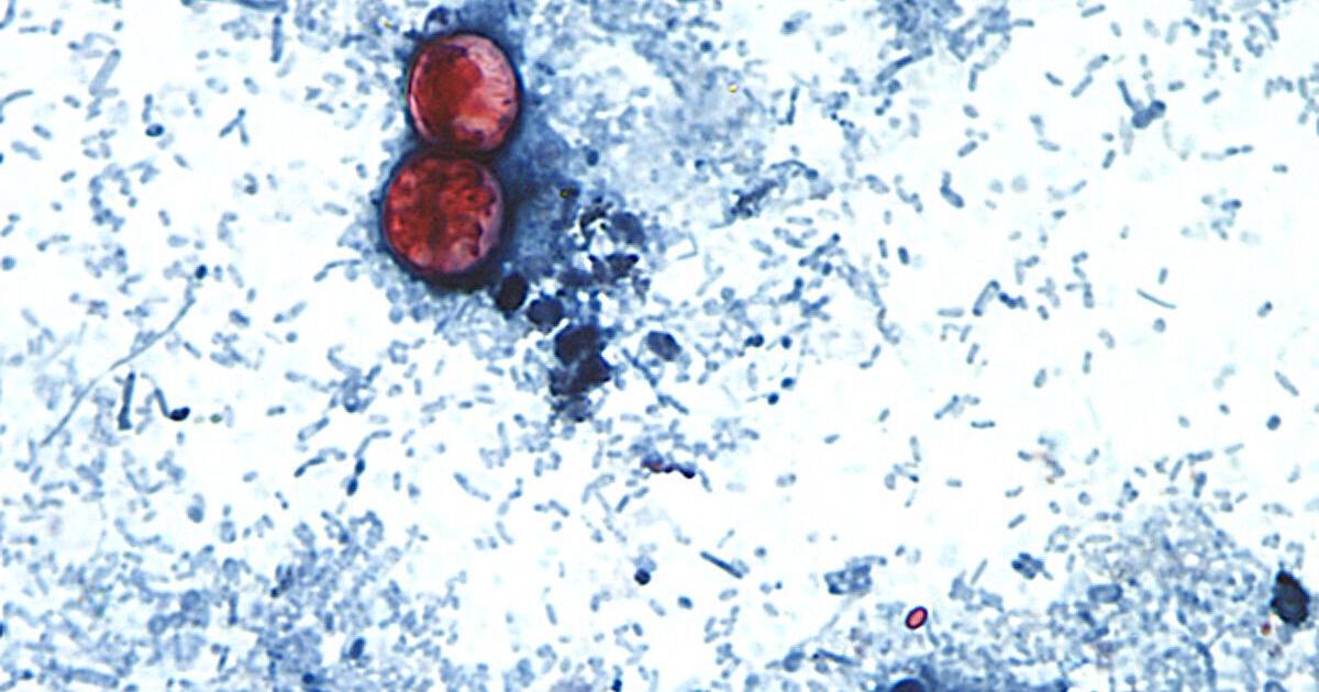 2 deaths from cyclosporiasis reported in Michigan Ohio has the second-highest number of cyclosporiasis cases, behind Michigan Aug 4, 2026 Aug 4, 2026 Updated 19 mins ago