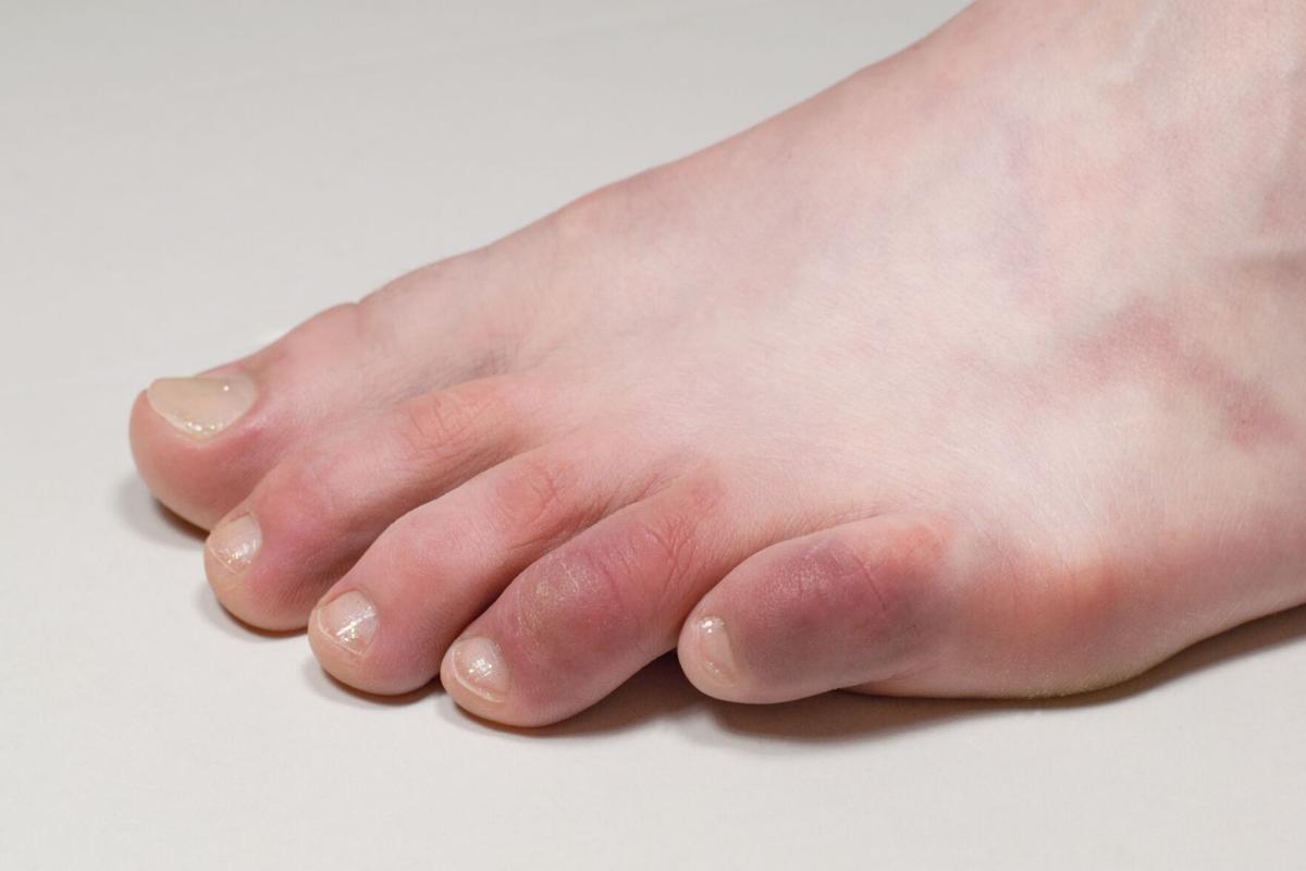 Dermatologist suggests foot rash might be symptom of COVID-19