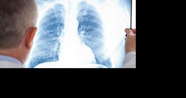 Nebraska lags in screening for lung cancer - Vimarsana News