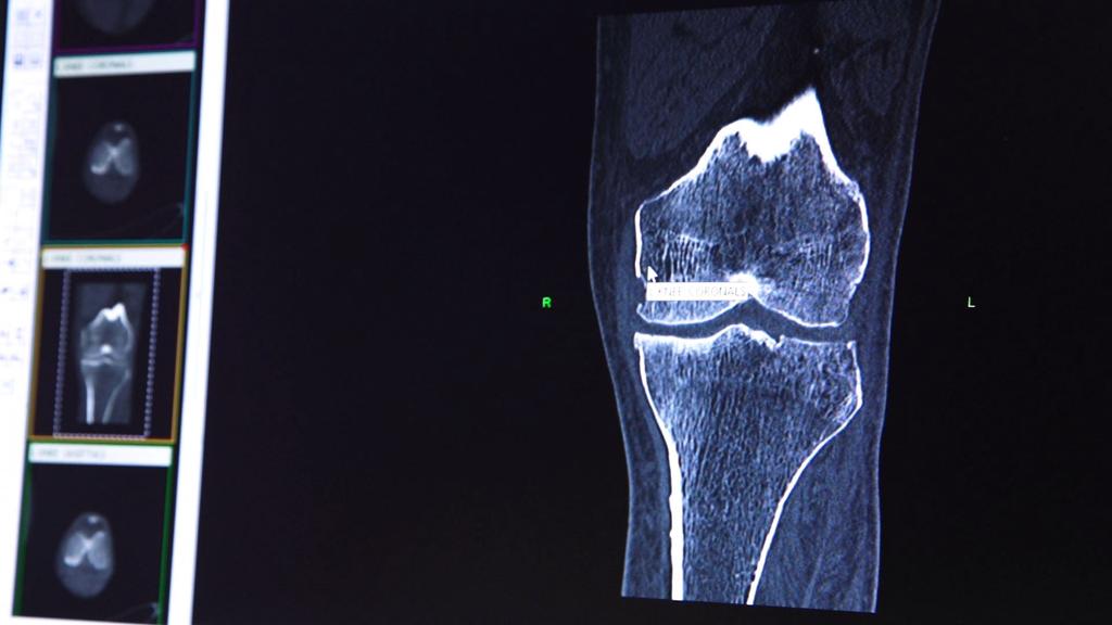 Lincoln Surgeon One Of Few Doing Customized Knee Replacement