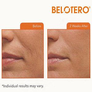 belotero1.jpg