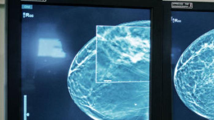 Lincoln Woman Credits 3 D Mammography With Saving Her From Cancer