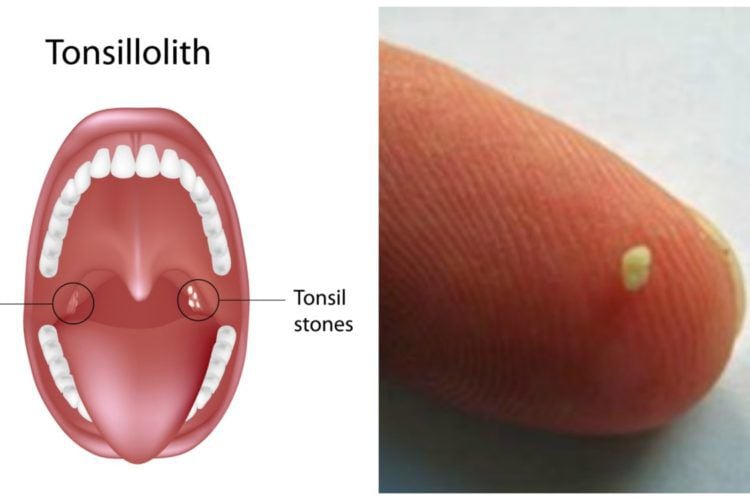 Early Tonsil Stones Tonsil Stones Removal Tips