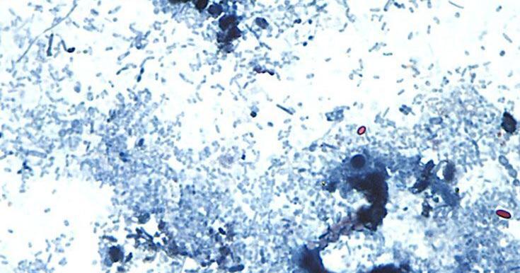 Massive cyclosporiasis outbreak linked to Kansas