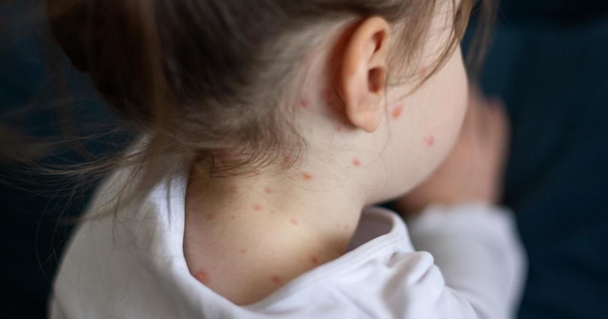 6 Kansans under age 18 test positive for measles: KDHE - KAKE